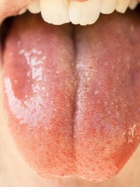 Owrzodzenie jamy ustnej – przyczyny, objawy, leczenie