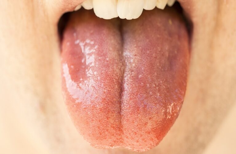 Owrzodzenie jamy ustnej – przyczyny, objawy, leczenie